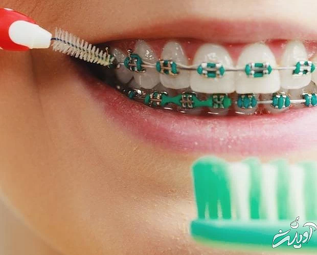 مسواک ارتودنسی و تغذیه در ارتودنسی